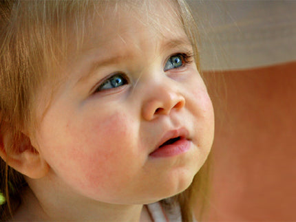 Symptom Spotlight: Toddler Eczema
